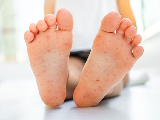 Hand foot & mouth disease