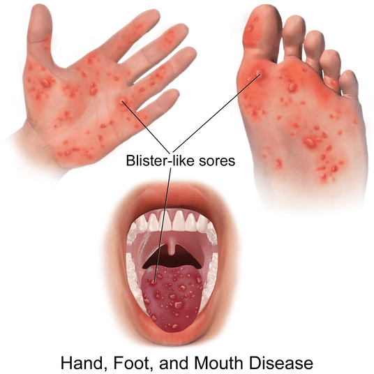 Hand foot & mouth disease